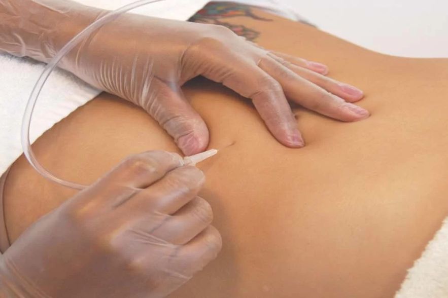 Enzimas Gordura localizada Flacidez Celulite Estrias